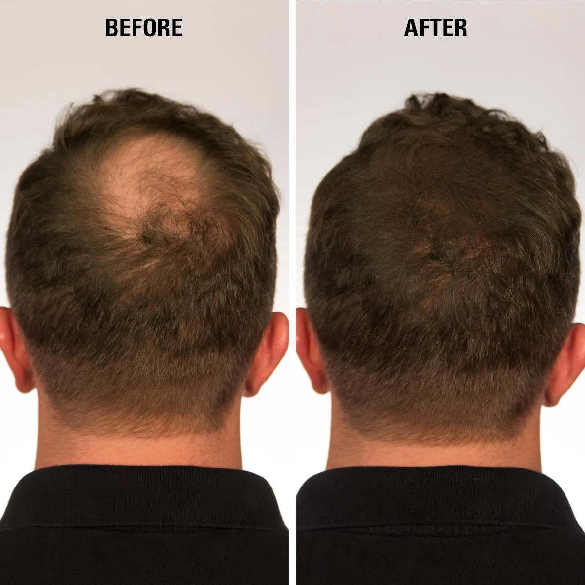 Hair Fibers White for Thinning Hair for Women & Men - 100% Undetectable Hair Building Fiber Powder, 30g