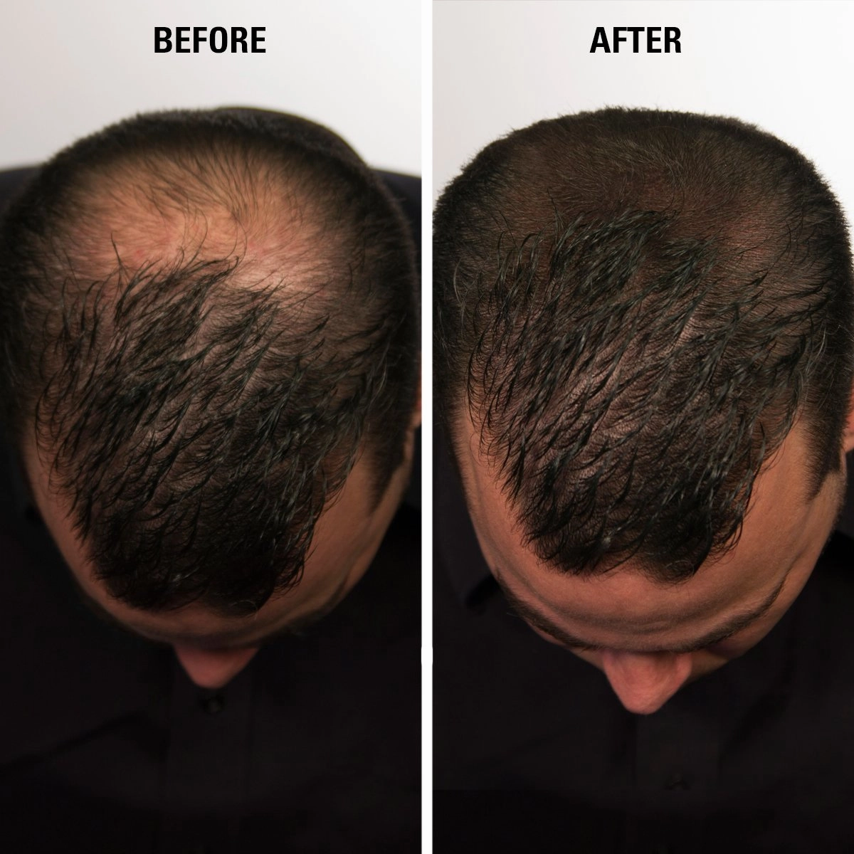 Hair Fibers Dark Brown for Thinning Hair for Women & Men - 100% Undetectable Hair Building Fiber Powder - Conceal Hair Loss in 15 Seconds, 30g