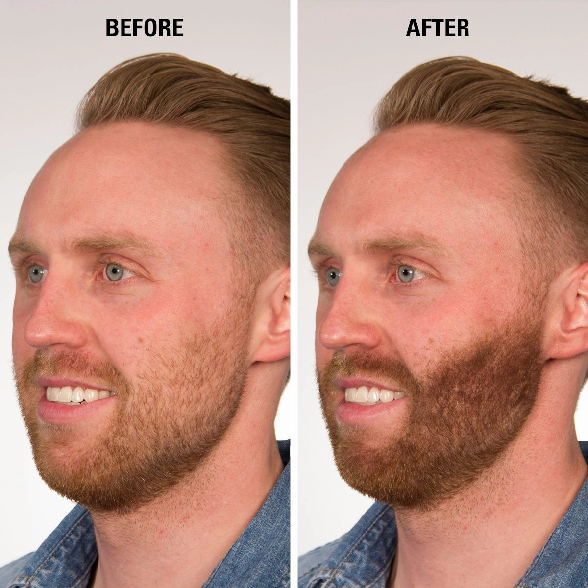 Hair Fibers Dark Brown for Thinning Hair for Women & Men - 100% Undetectable Hair Building Fiber Powder - Conceal Hair Loss in 15 Seconds, 30g